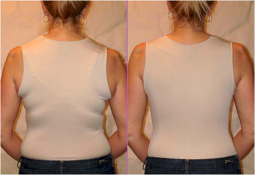 Real Life transformations in our No Back Fat Bra - Before & After Pictures